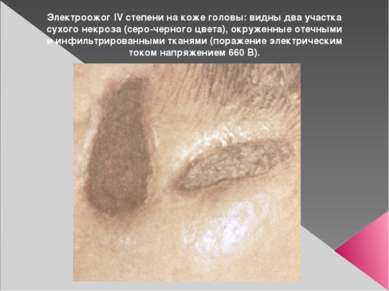 Электроожог IV степени на коже головы: видны два участка сухого некроза (серо...