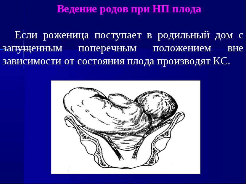 Ведение родов при НП плода Если роженица поступает в родильный дом с запущенн...