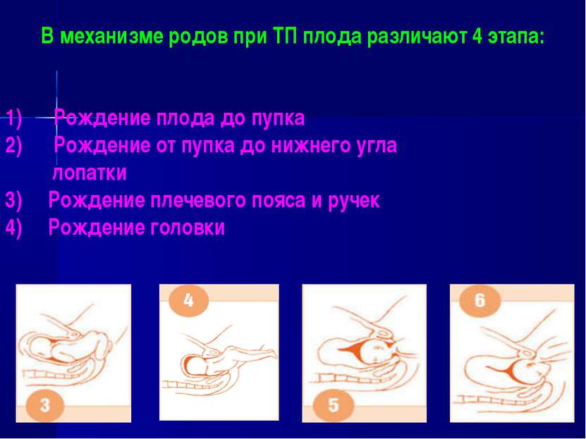 В механизме родов при ТП плода различают 4 этапа: Рождение плода до пупка Рож...
