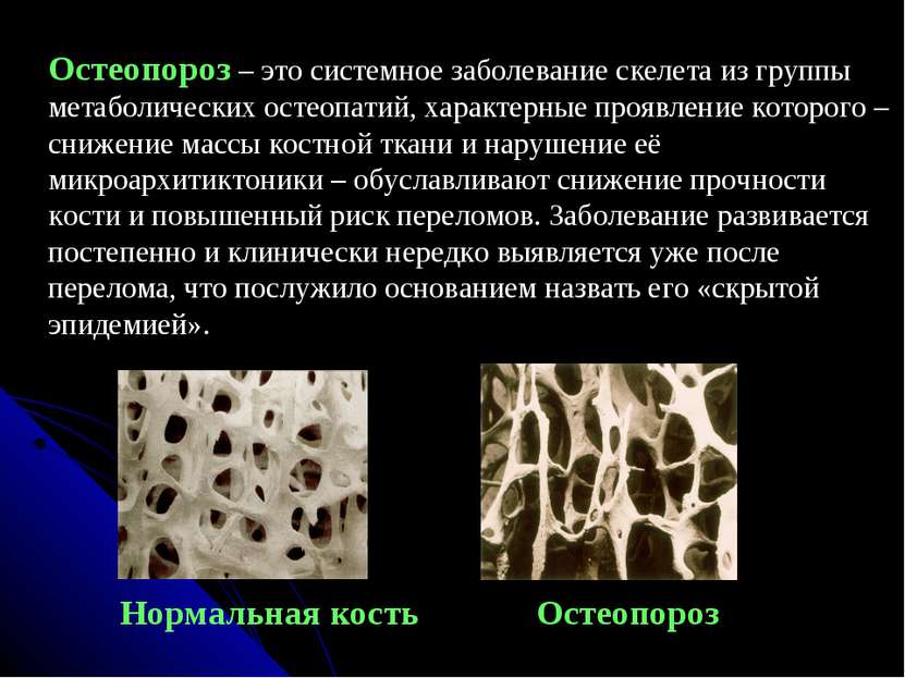 Нормальная кость Остеопороз Остеопороз – это системное заболевание скелета из...