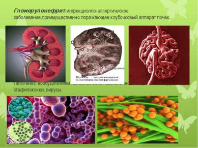 Гломерулонефрит-инфекционно-аллергическое заболевание,приимущественно поражаю...