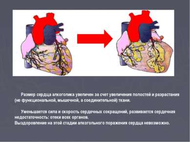 Размер сердца алкоголика увеличен за счет увеличения полостей и разрастания (...