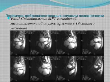 Первично-доброкачественные опухоли позвоночника Рис.1 Сагиттальные МРТ гигант...