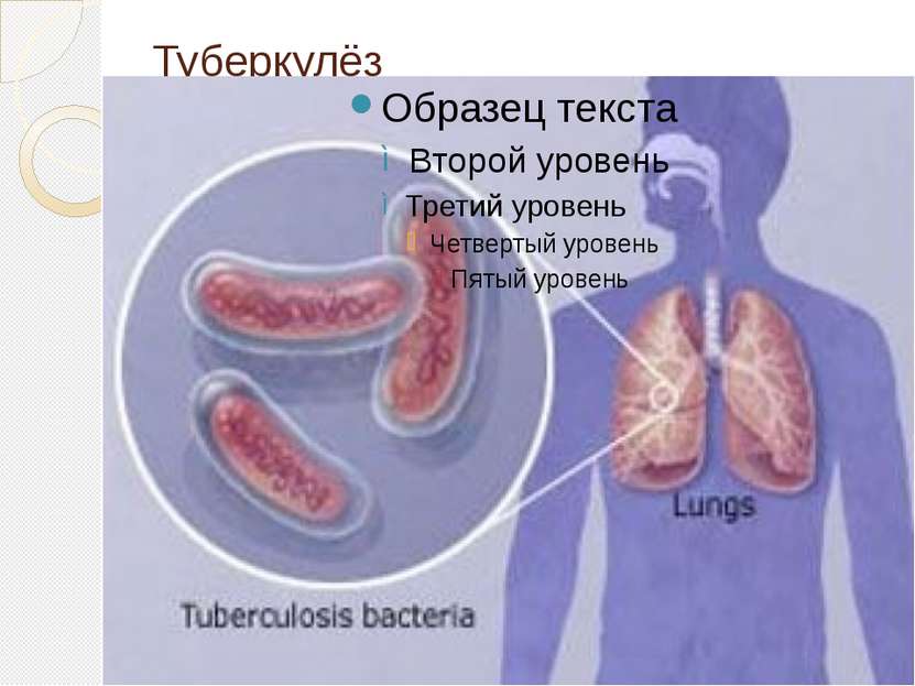 Туберкулёз
