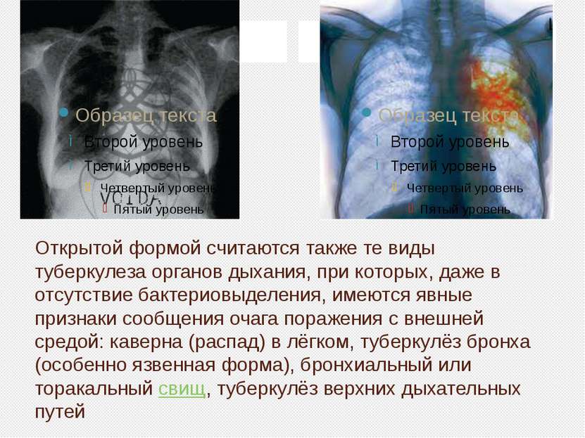 Открытой формой считаются также те виды туберкулеза органов дыхания, при кото...