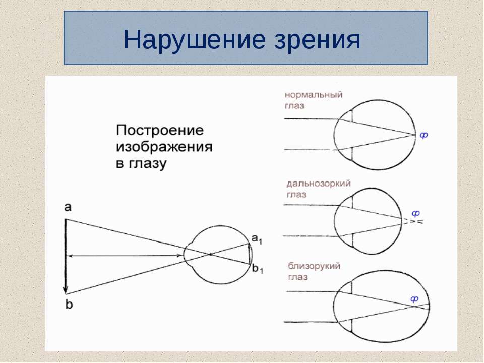 Как называют нарушение зрения при котором зрительное восприятие человека соответствует рисунку 2