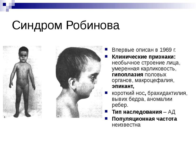 Синдром Робинова Впервые описан в 1969 г. Клинические признаки: необычное стр...