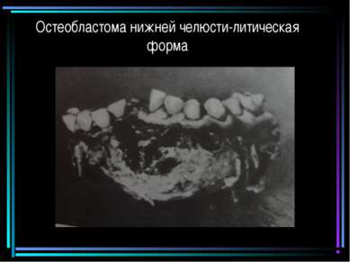 Остеобластома нижней челюсти-литическая форма