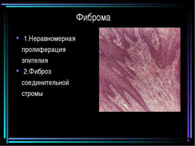 Фиброма 1.Неравномерная пролиферация эпителия 2.Фиброз соединительной стромы