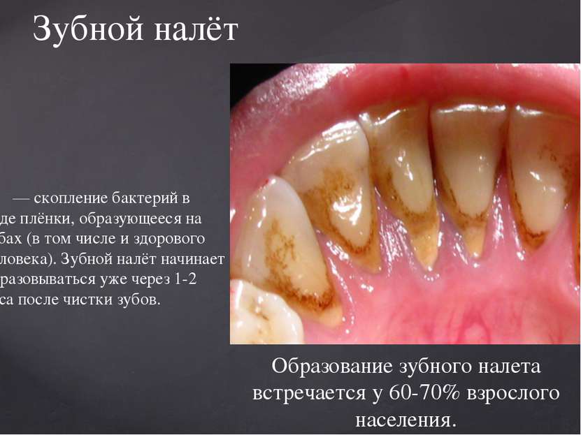 — скопление бактерий в виде плёнки, образующееся на зубах (в том числе и здор...