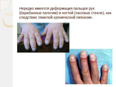 Нередко имеется деформация пальцев рук (барабанные палочки) и ногтей (часовые...