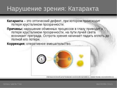 Нарушение зрения: Катаракта Катаракта – это оптический дефект, при котором пр...