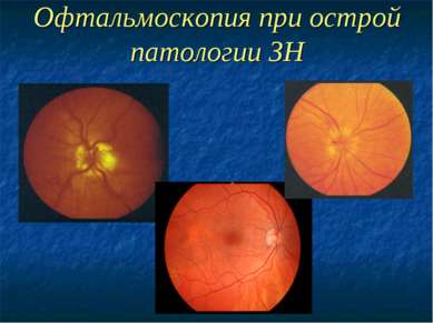 Офтальмоскопия при острой патологии ЗН