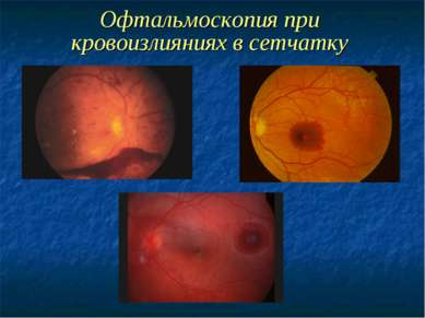 Офтальмоскопия при кровоизлияниях в сетчатку